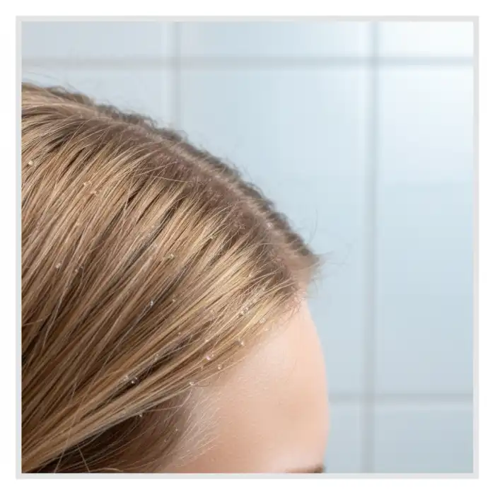 Jak pozbyć się łupieżu w 1 dzień? Skuteczne sposoby na skórę głowy